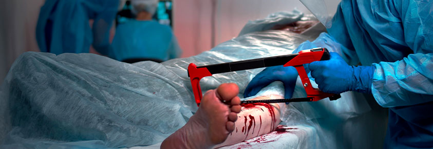Chirurg mit Säge bei einer Beinamputation im Operationssaal